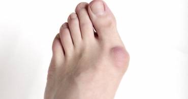 Alluce valgo: migliora la salute del piede in farmacia